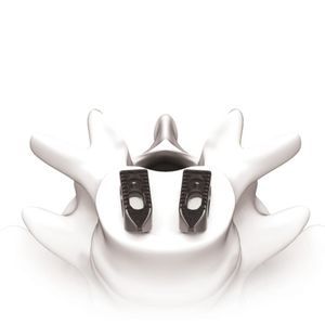 gabbia intersomatica toraco-lombare 1