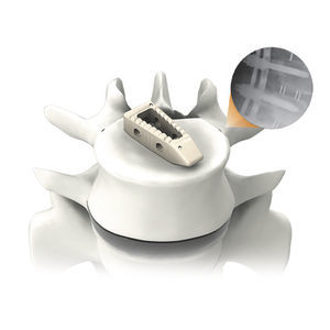 gabbia intersomatica toraco-lombare 1