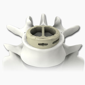 gabbia intersomatica lombare 1