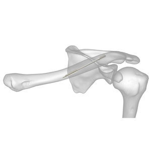 vite per compressione ossea per clavicola