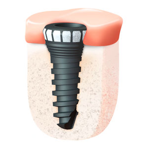 impianto dentale conico