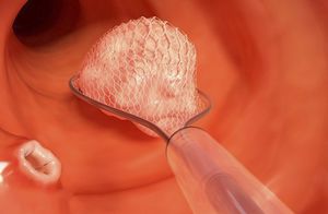 pinza per endoscopia