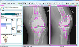 software di pianificazione preoperatoria