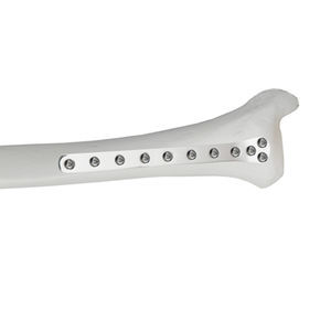 placca di compressione per tibia 1
