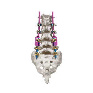 sistema di osteosintesi toraco-lombo-sacrale 1