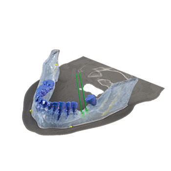 Software per implantologia dentale - Reconstruction 3D - Drive Dental Implants - di simulazione d'impianto dentale / di visualizzazione 3D / di modelizzazione