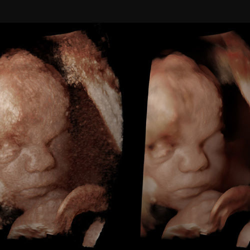 Software per ecografia - Rivent 3D - ContextVision - di analisi di dati / di visualizzazione 3D / ginecologia