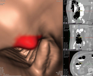 Algoritmo di visualizzazione - VeraLook® - iCAD - di ausilio al rilevamento / clinico / di colon