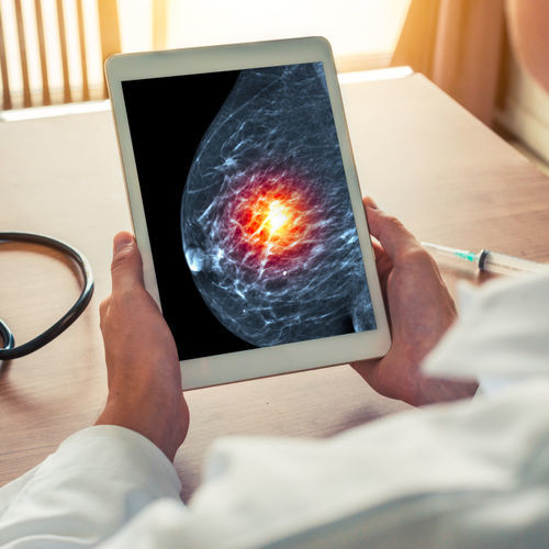 Algoritmo diagnostico - SecondLook® - iCAD - di analisi / di trattamento / per screening del tumore al seno