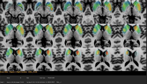 Software di analisi - Hermes Medical Solutions, Inc - di visualizzazione / medico / TEP