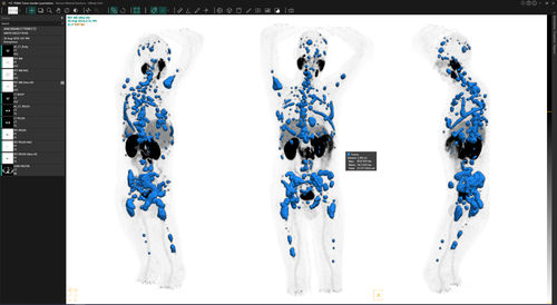 Software di trattamento - Voxel dosimetry™ - Hermes Medical Solutions, Inc - di validazione / clinico / per tomografia computerizzata