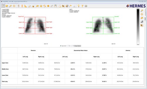 Software di analisi - Lung Lobe Quantification™ - Hermes Medical Solutions, Inc - diagnostico / di pianificazione / di valutazione