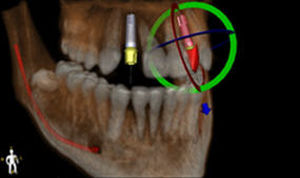 Software per chirurgia - Blue Sky Plan - BlueSkyBio - per implantologia dentale / di visualizzazione 3D / di pianificazione