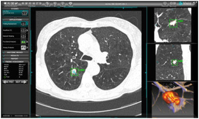 Software di analisi - MeVis Medical Solutions AG - CAD / di valutazione / di quantificazione
