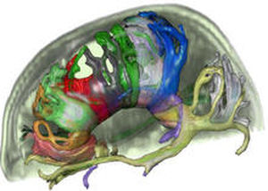 Software di analisi - MeVis Medical Solutions AG - di pianificazione / MRI / per chirurgia