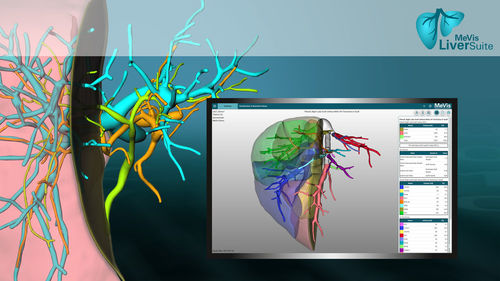 Software di analisi delle immagini - LiverSuite - MeVis Medical Solutions AG - di visualizzazione / di pianificazione del trattamento / di importazione d'immagini mediche