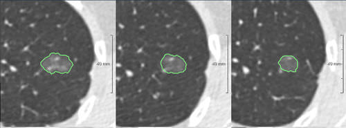 Software diagnostico - Veolity™ - MeVis Medical Solutions AG - CAD / di rilevamento / per screening del tumore del pomone