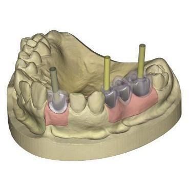 modulo software per implantologia dentale - Champions Implants GmbH