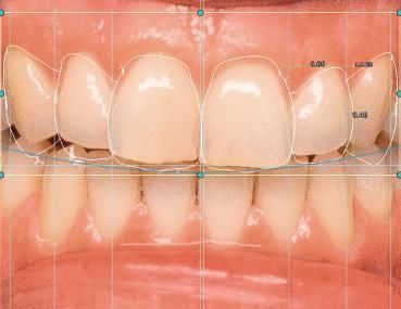 Modulo software odontoiatrico - 4218 - Champions Implants GmbH - di progettazione / CAD / di progettazione digitale del sorriso