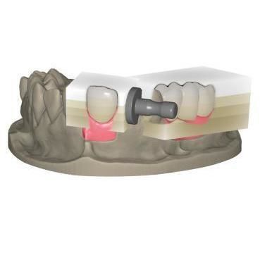 Modulo software per ricostruzione dentale - In-Cad Nesting - Champions Implants GmbH - di progettazione / di fabbricazione / di denti
