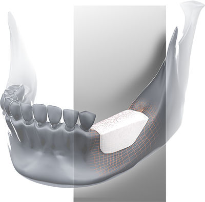 Sostituto osseo allotrapianto - Global D - per chirurgia dentale / rigido