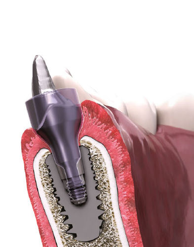 Vite di guarigione - IN-KONE® - Global D