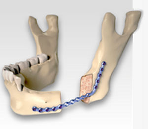 Placca per osteotomia per mandibola - CARCITEK  - Global D - bloccata / in metallo