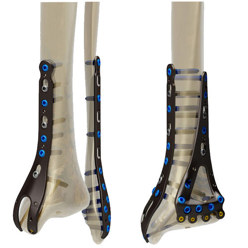 Placca di compressione per fibula -  STEP® - Response Ortho - per tibia / distale / non bloccata