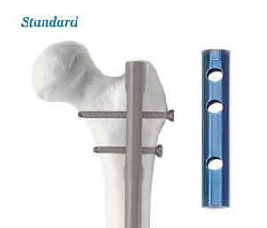 Chiodo intramidollare per femore - AOS - Advanced Orthopaedic Solutions