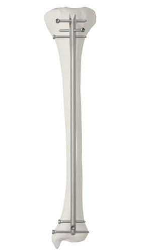 Chiodo intramidollare per tibia - Da Vinci™ - AOS - Advanced Orthopaedic Solutions - fissazione prossimale / fissazione distale