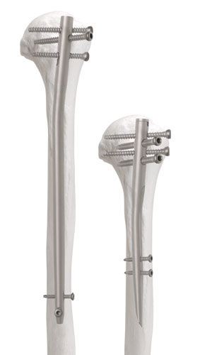 Chiodo intramidollare per omero - Newton™ - AOS - Advanced Orthopaedic Solutions - fissazione prossimale