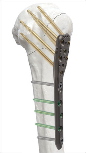 Placca di compressione per omero - AOS - Advanced Orthopaedic Solutions - prossimale / bloccata / in metallo