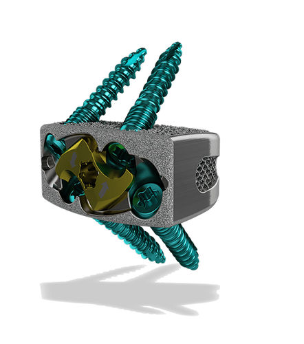 Gabbia intersomatica lombare - Harrier® SA - ChoiceSpine - via anteriore / in titanio / stampata in 3D