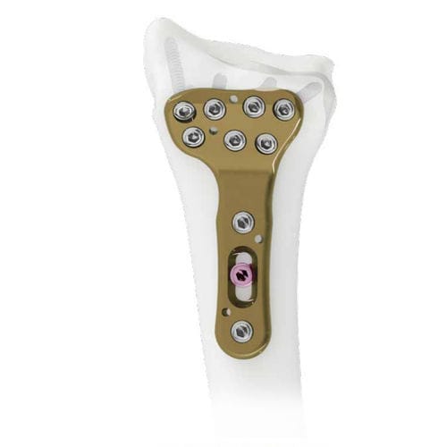 Placca di compressione per radio - Wristar - Intrauma - distale / bloccata / in metallo