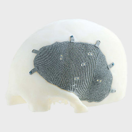 Impianto cranico su misura - Medyssey Spine
