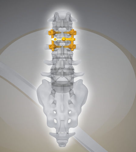 Sistema di osteosintesi lombare - NEX D2 - Next Orthosurgical - via posteriore / per adulti