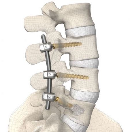 Sistema di osteosintesi toraco-lombare - DIPLOMAT®  - Signus Medical - via posteriore / per adulti