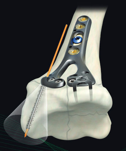 Placca di compressione per radio - GEMINUS ® - Skeletal Dynamics - distale / in metallo