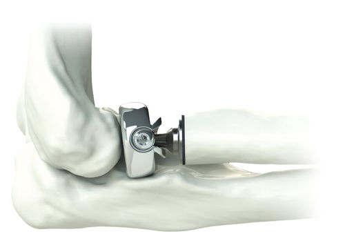 Protesi di testa del radio - ALIGN ® - Skeletal Dynamics