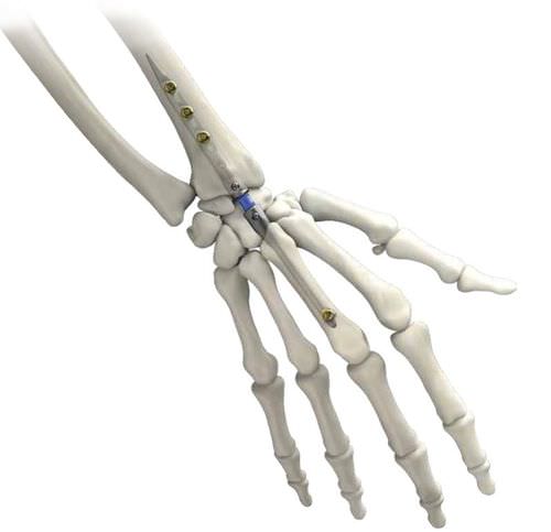 Chiodo intramidollare per polso - IMPLATE ® - Skeletal Dynamics