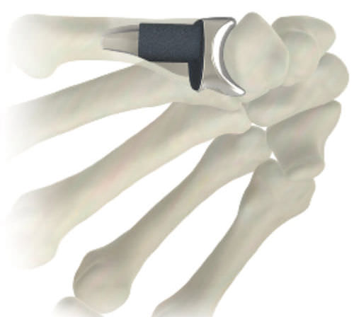 Impianto metacarpo-falangeo - STABLYX ® - Skeletal Dynamics