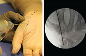 Vite per artrodesi per articolazione metacarpo-falangea - REDUCT™ - Skeletal Dynamics - per falange della mano / senza testa / in metallo