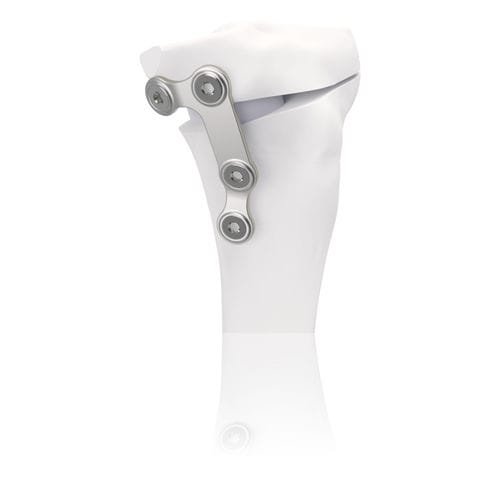 Placca per osteotomia per tibia - TBFIX™ - Groupe Lépine - in acciaio inossidabile