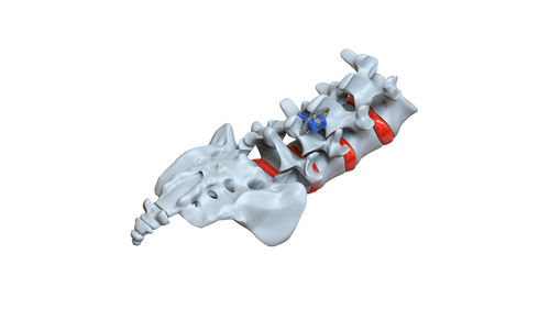 Impianto vertebrale interspinale lombare - STRATOS - Osimplant