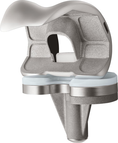 Protesi di ginocchio tricompartimentale - U2™  - US Orthopedics - a piatto fisso