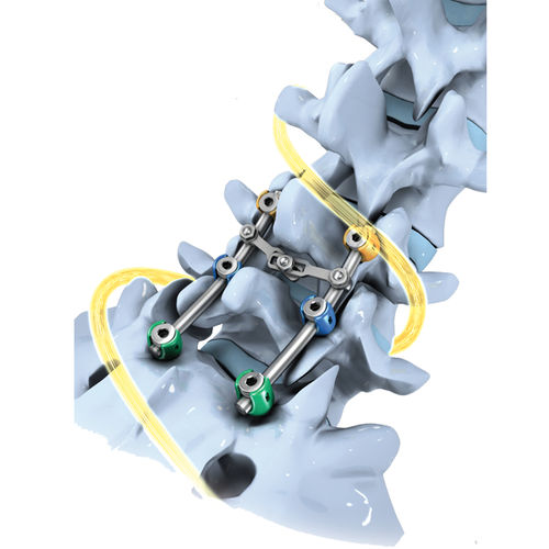 Sistema di osteosintesi lombo-sacrale - SLICK'S® - Biotechni - via posteriore / per adulti