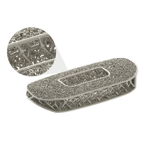 Gabbia intersomatica cervicale - Modulus® - NuVasive - via anteriore / in titanio