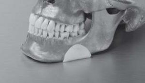 Impianto mandibolare - OP7550 - Matrix Surgical USA - anatomico / in polietiline