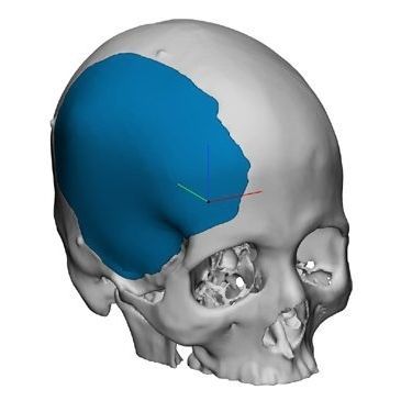 Impianto cranico su misura - OP89020 - Matrix Surgical USA