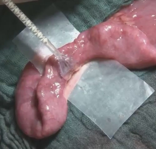 Colla chirurgica per chirurgia vascolare - VIVO - Adhesys Medical